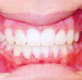 alyssa-reid-teeth-after