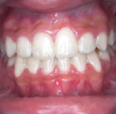 breiana-wilson-teeth-after