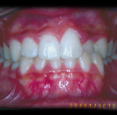breiana-wilson-teeth-before