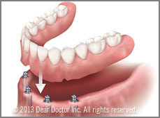Implant-secured dentures