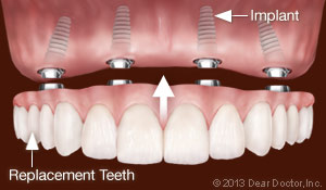 Dental Implants Replace All Teeth
