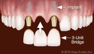 Dental Implants Replace Multiple Teeth