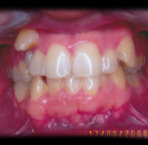 jose-villalobos-teeth-before