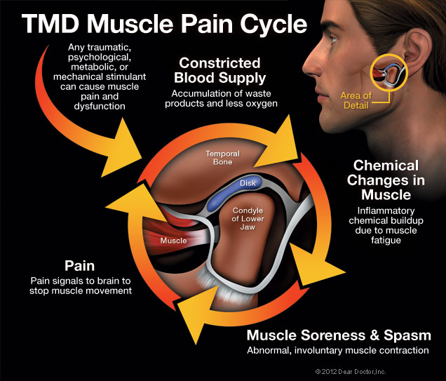 TMD Pain Cycle