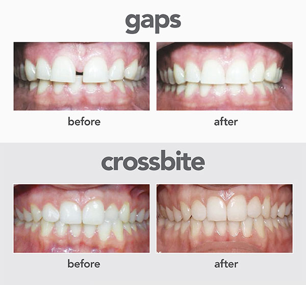 gaps crossbite