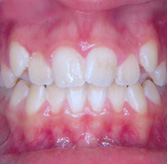alyssa-reid-teeth-before