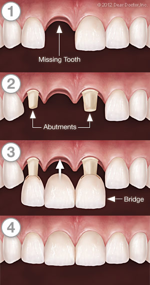 Dental Bridgework
