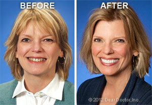 Before and After Cosmetic Dentistry.