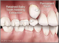 Retained Baby Tooth