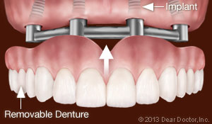 Dental Implants Support Removable Dentures