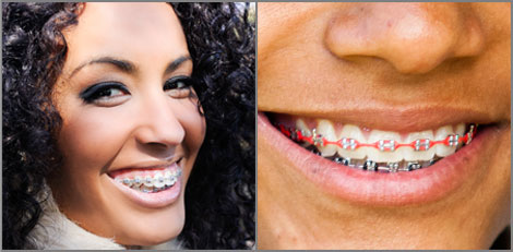 Types Of Dental Braces Coast Dental