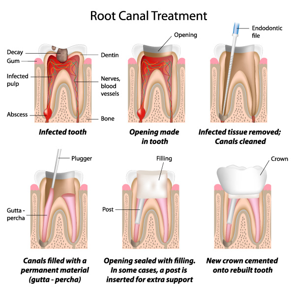 What is a root canal