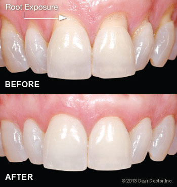 Gum Grafting before and after.