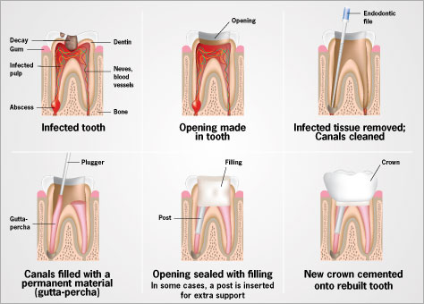 Root canal treatment.