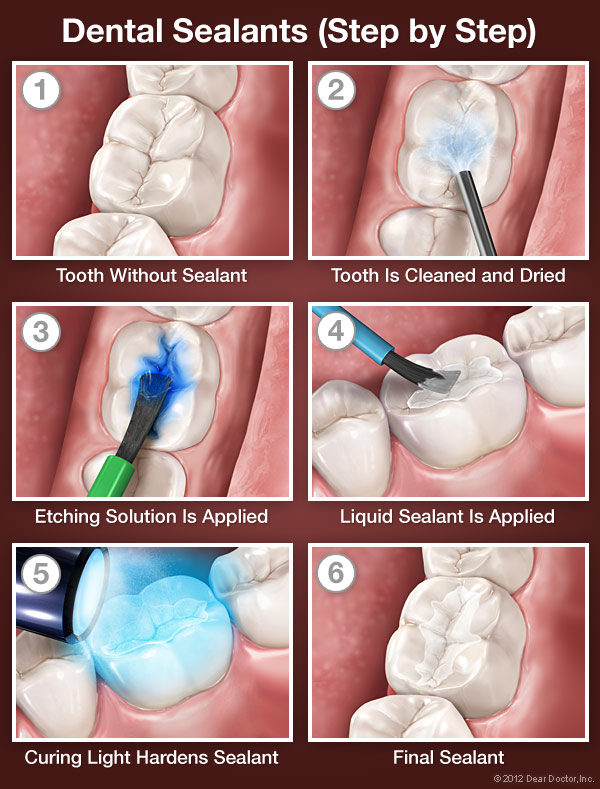 Dental Sealants - Step by Step