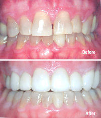 Tetracycline stained teeth covered by crowns on 8 top teeth.