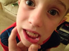 child with bit lip image
