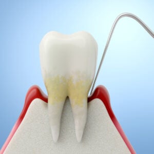 BLOG-Periodontal Disease