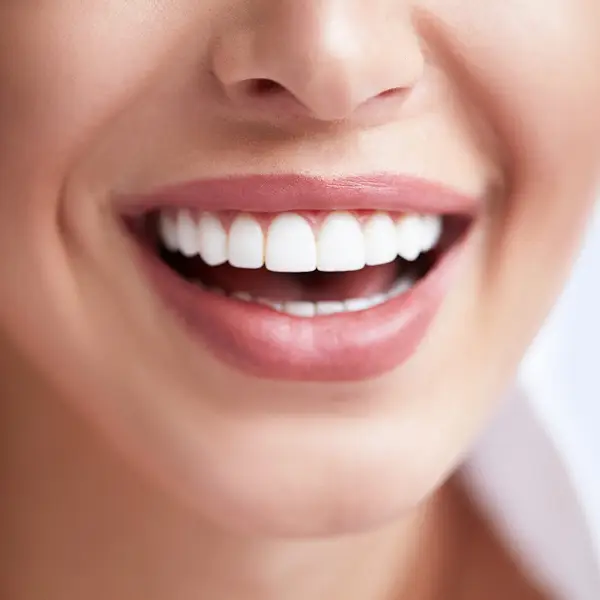 Smile-Makeover