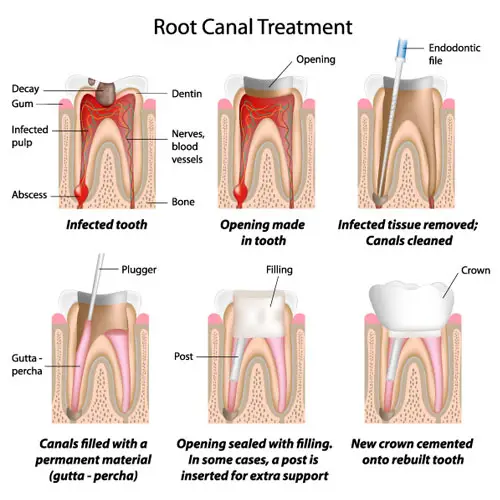 Blog-rootcanaltreatment