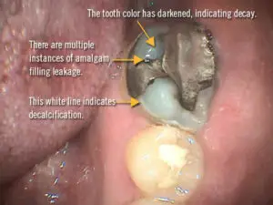 amalgam-filling-leakage