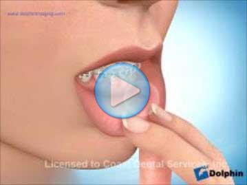 Braces Wax
