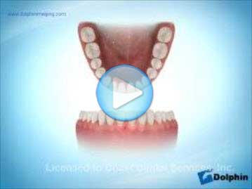 Broad Archform Mandible