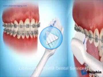 Brushing with Braces