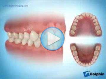 Class 1 Crossbite Anterior Tooth