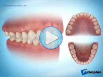 Class 1 Crossbite Buccal