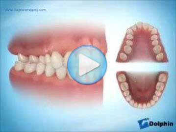 Class 1 Crossbite Palatal