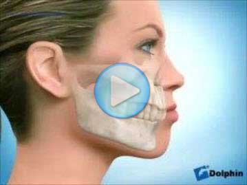 Class 2 Overbite Lip Protrusion