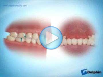 Class 2 Overbite No Correction