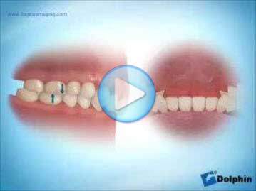 Class 2 Overbite