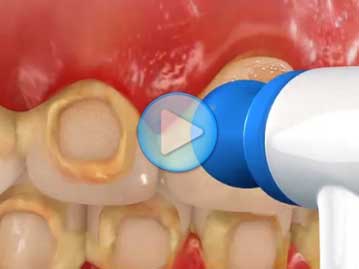 Decalcification Poor Hygiene