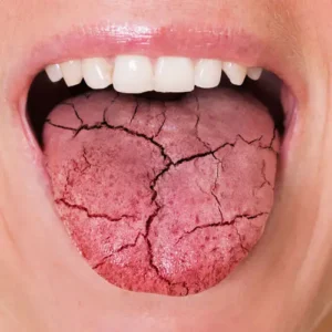 drymouth