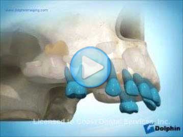 Early Loss Primary First Molar