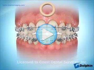 Elastics Anterior Open Bite