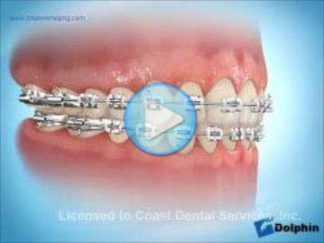 Elastics Asymetric