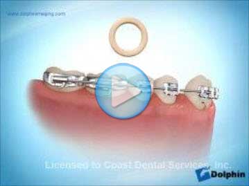 Elastics Class 1 Mandibular