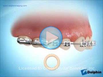 Elastics Class 1 Maxillary