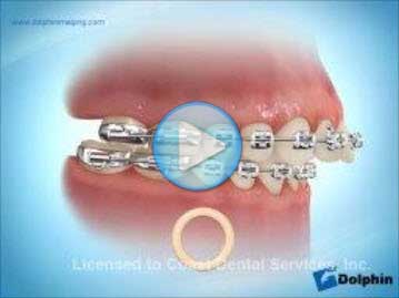 Elastics Class 2 Overjet
