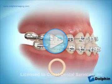 Elastics Class 3 Underbite
