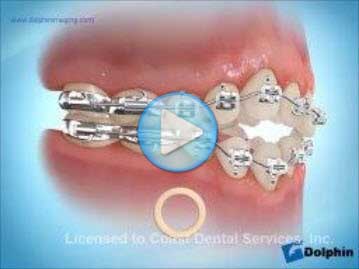 Elastics Delta Canine Open Bite