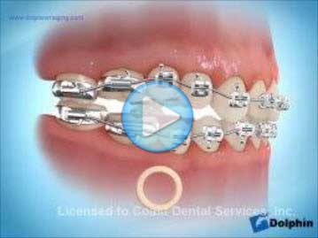 Elastics Delta First Molar Open Bite