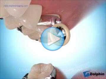 Elastics Palatal Crossbite