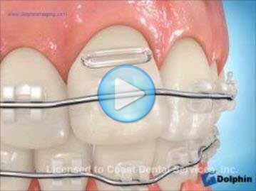 Elastomeric Ligation Clear Brackets