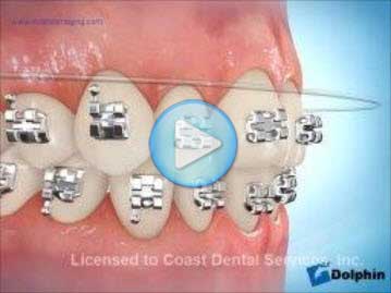 Elastomeric Ligation Colored