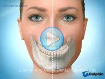 Facial Asymmetry Mandible