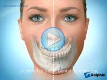 Facial Asymmetry Maxilla Mandible